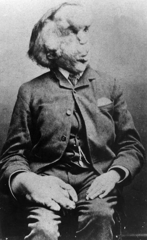 Joseph Merrick, the Elephant Man