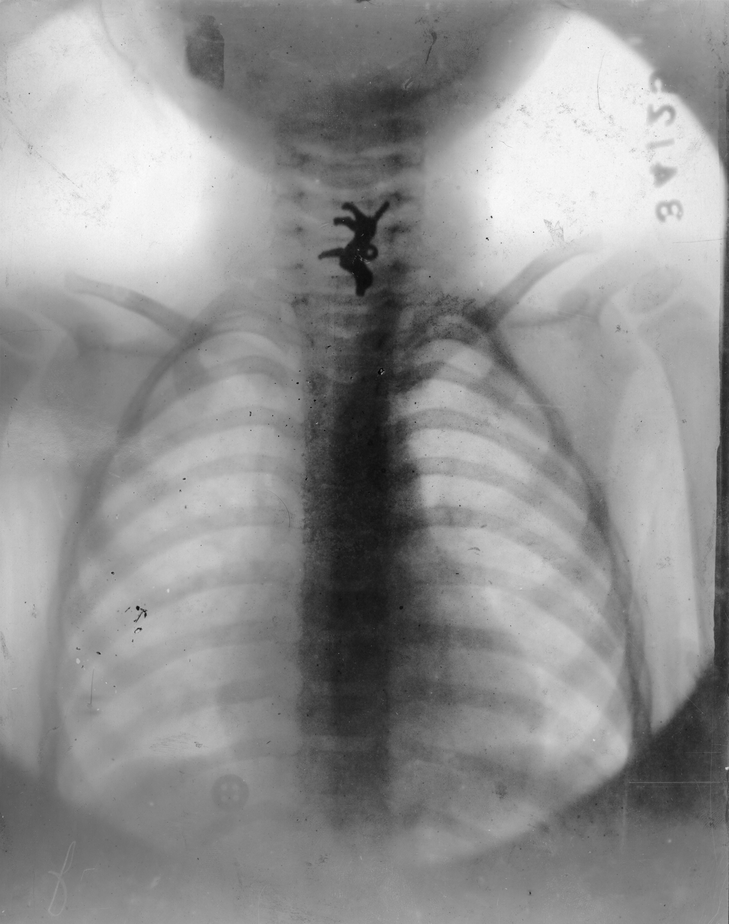 From the collection of the Mutter Museum, The College of Physicians of Philadelphia
