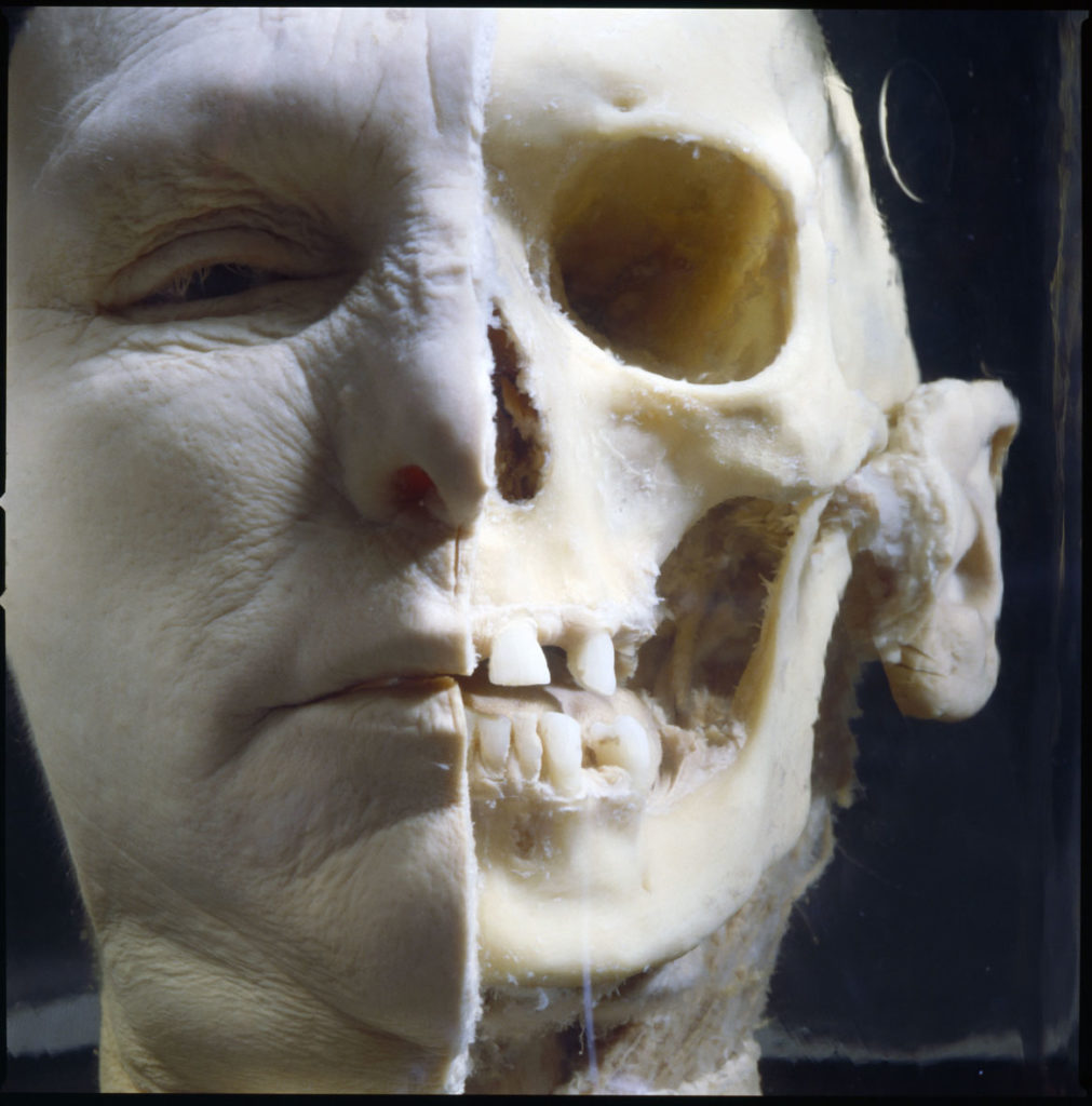 Half flesh, half skull. Courtesy of Hans van den Bogaard/Museum Vrolik