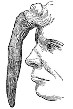 This illustrated human horn, as seen in "Anomalies and Curiosities of Medicine" is based off a wax model.