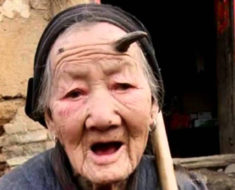 Human horns on 101-year-old Zhang Ruifang