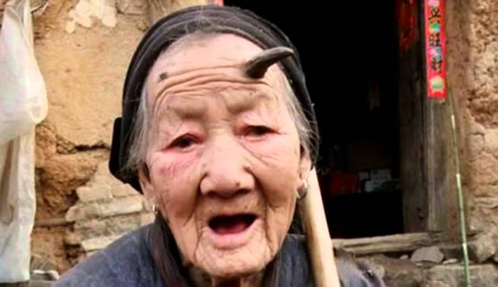 Human horns on 101-year-old Zhang Ruifang