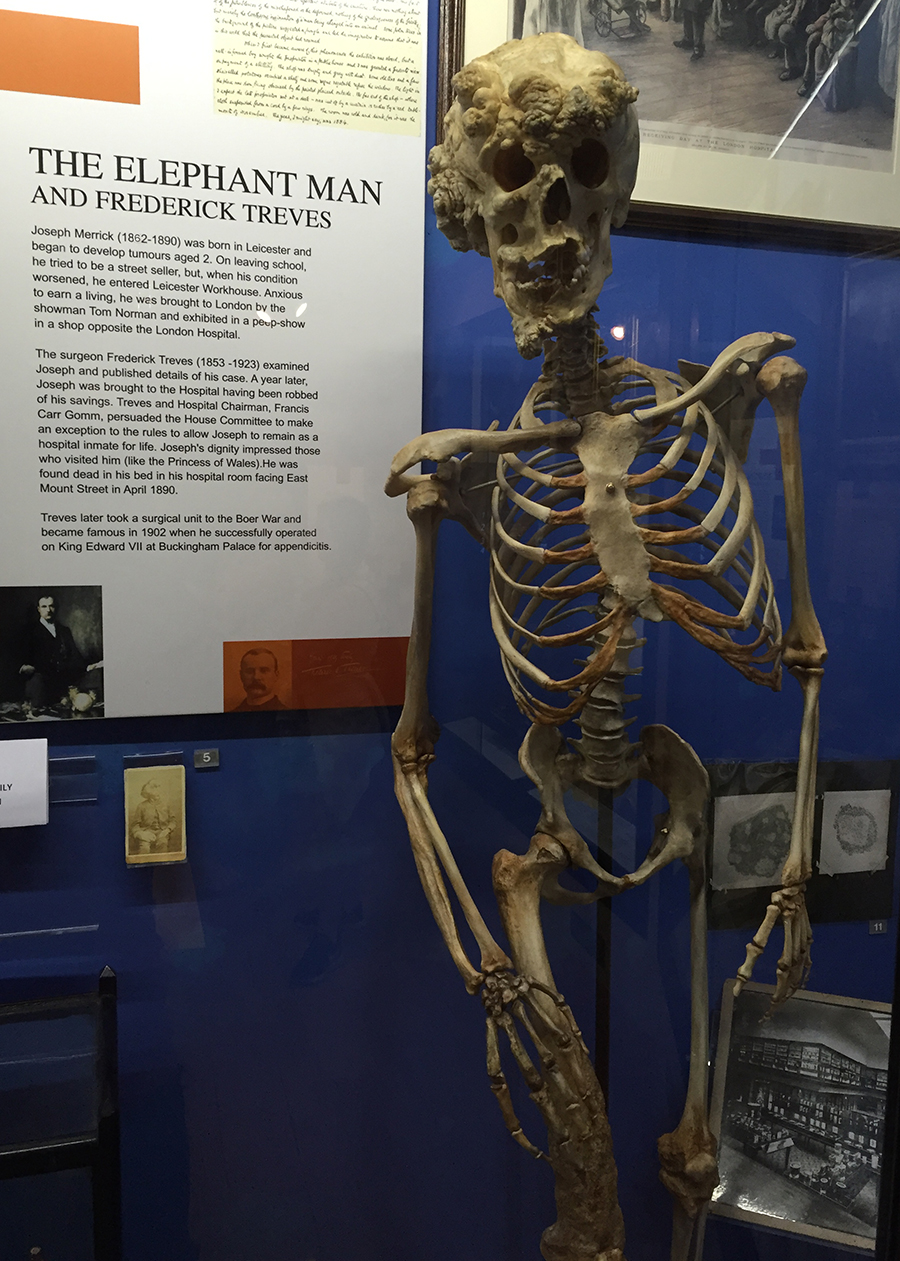 Replica of the Elephant Man's bones at the Royal London Hospital. Photo by Marc Hartzman.