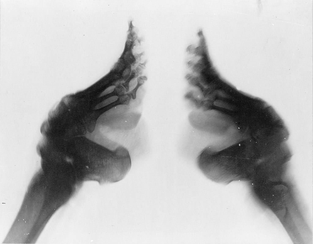 X-ray of bound feet. By unknown; Frank and Frances Carpenter Collection. [Public domain], via Wikimedia Commons.