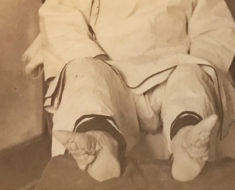 Stereoview of Chinese "Lily Feet." With a viewer, you can see her unwrapped feet in 3D. Marc Hartzman Collection.