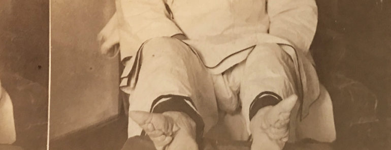 Stereoview of Chinese "Lily Feet." With a viewer, you can see her unwrapped feet in 3D. Marc Hartzman Collection.