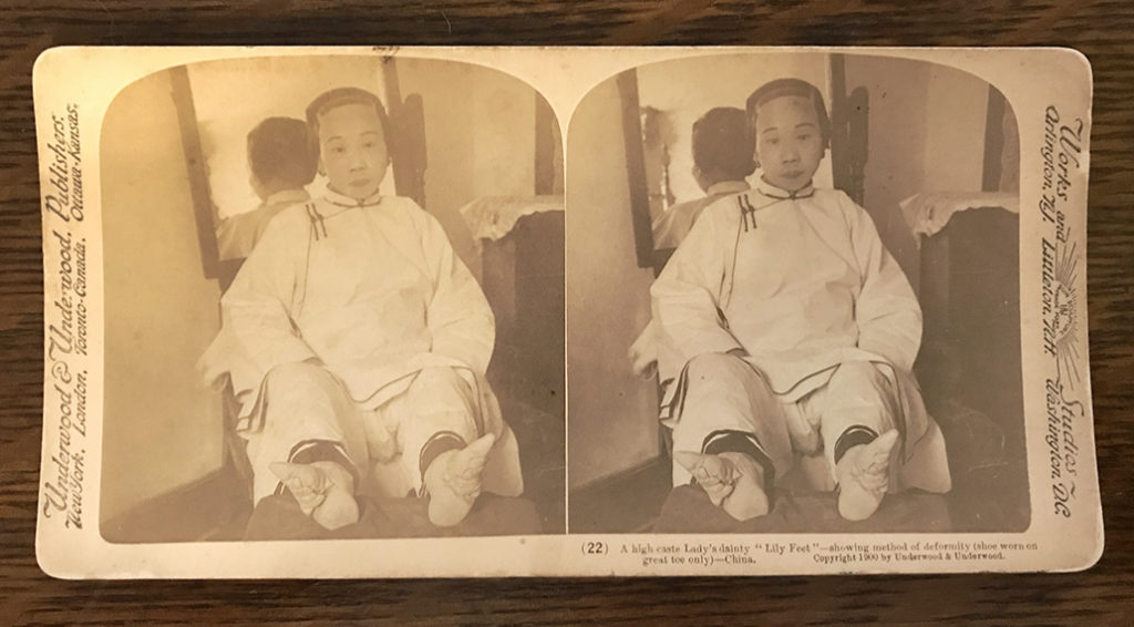 Stereoview of Chinese "Lily Feet." With a viewer, you can see her unwrapped feet in 3D. Marc Hartzman Collection.