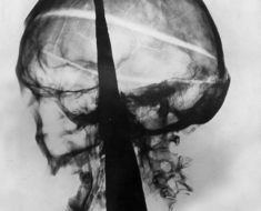 X-ray of Cromwell's head showing the iron spike from Westminster Hall.