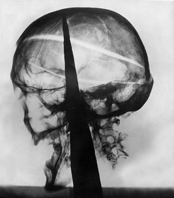 X-ray of Cromwell's head showing the iron spike from Westminster Hall.