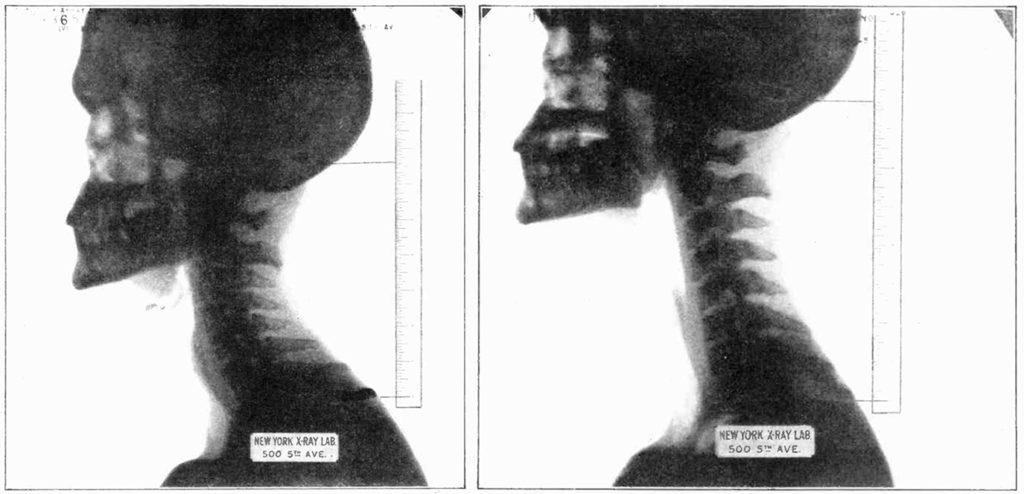 X-rays of Willard, taken for the September 1927 issue of Science and Invention. The images show how Willard straightened his neck to aid his growth.