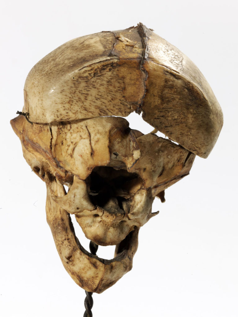 Skull with cyclopia. Courtesy of Hans van den Bogaard/Museum Vrolik.
