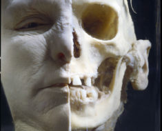Half flesh, half skull. Courtesy of Hans van den Bogaard/Museum Vrolik